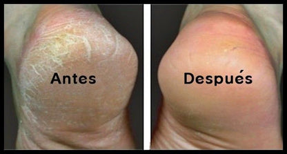 ✨ Removedor Eléctrico de Callos® – Pies Suaves en Minutos, Sin Dolor